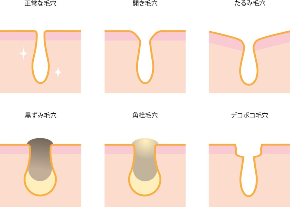 よくある毛穴トラブル