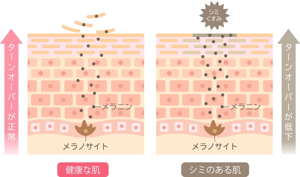 角質肥厚（ターンオーバーの乱れ）
